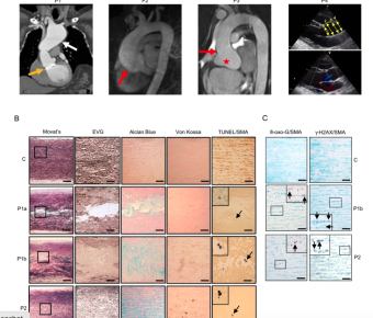 Selenoprotein deficiency disorder predisposes to aortic aneurysm formation